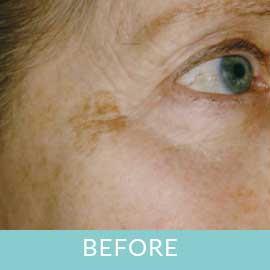 pigment-before